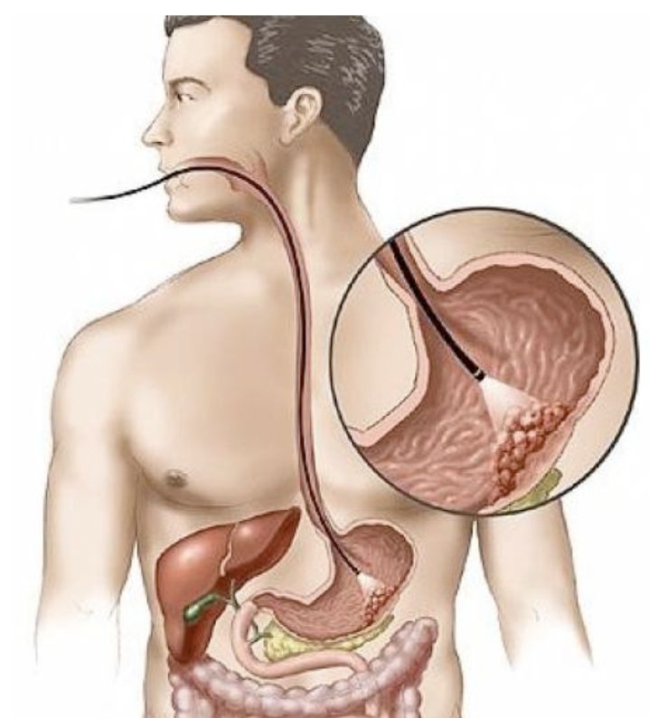 Cancer de l'estomac:
Cancer en régression mais dont le pronostic est
mauvais!
Là aussi, le facteur de risque principal est le