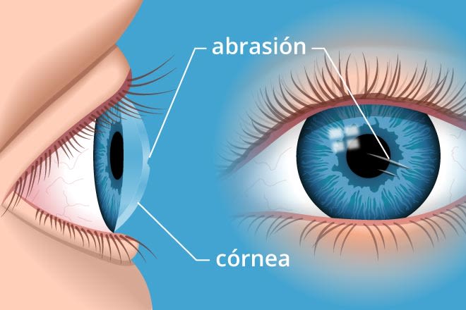 Abrasión Corneal