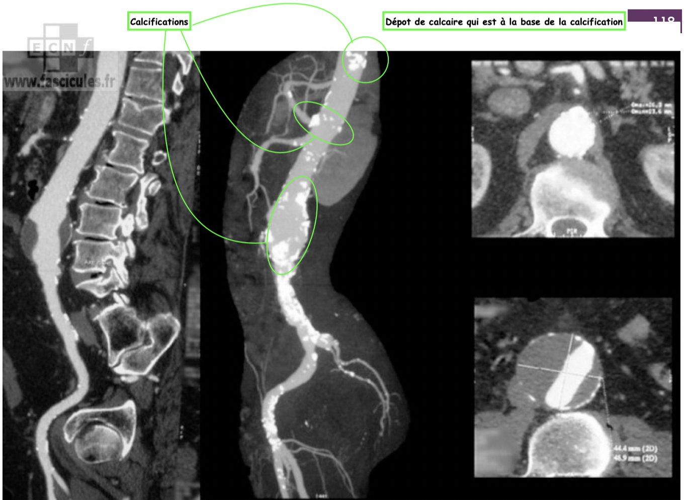 Calcification d’un anévrisme
A noter, que les anévrismes se calcifient souvent, ce qui signifie qu’ils sont visibles à la rad