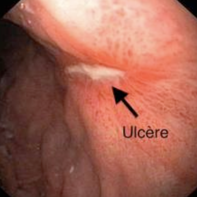 Ulcères duodénaux:
Classiquement l’ulcère duodénal donne des douleurs de type crampe, au niveau épigastriques, 2 - 4 heures a