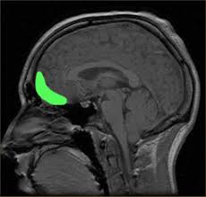 Daño en Corteza Prefrontal Orbital