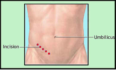 Incisions on the skin