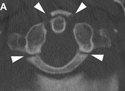 Fractura de Jefferson  
- Carga axial (simetrica)
- Descompresion➡️ Disrrupción de Arcos.
- Ensanchamiento canal.