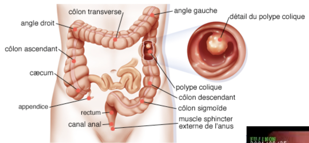 Tumeurs bénignes du côlon: les polypes:
Les adénomes ou polypes: tumeurs les plus
fréquentes!
Les polypes touchent plus de 10