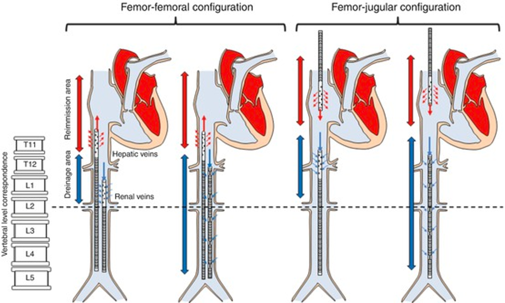 Dual Cannulation VV ECMO