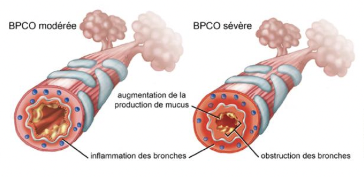 Les signes de la bronchopneumopathie chronique obstructive (BPCO) sont:
• Une toux similaire à celle de la bronchite aiguë, m