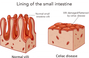 Normal villi vs Celiac disease