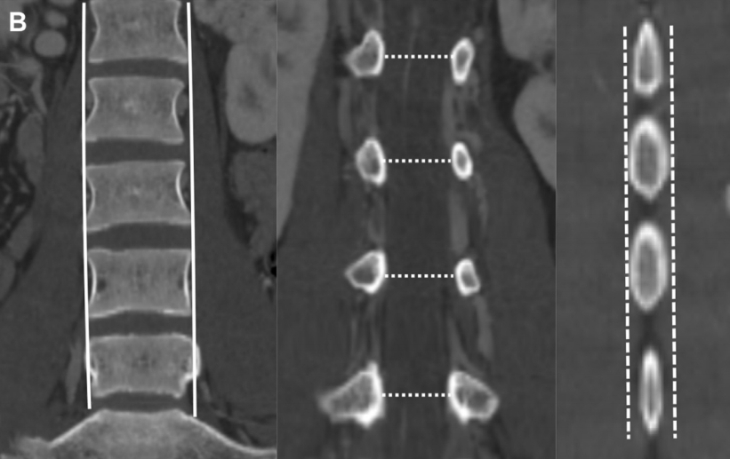 CORONAL