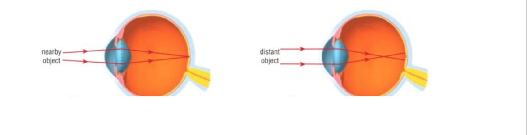 Comparison of Normal Vision (Left) and Myopia Vision (Right)