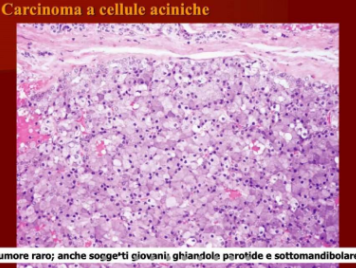 adenocarcinoma a cellule aciniche