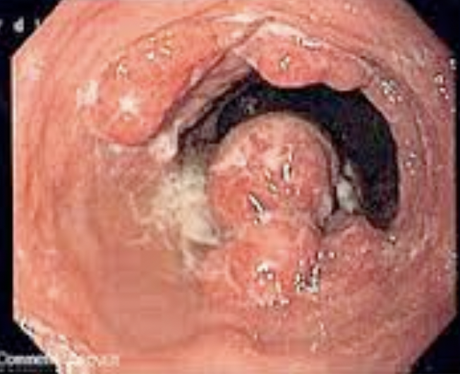 Diagnostic et traitement:
Le cancer de l’œsophage se diagnostique essentiellement par endoscopie.
Le seul traitement possible