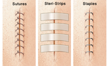 Stitches, staples, and stripes of tapes after the surgery