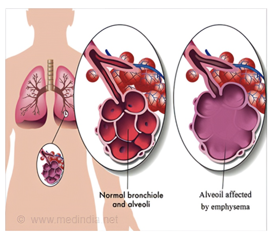 Quant à l’emphysème, il s’agit d’une maladie dégénérative des alvéoles pulmonaires qui entraîne la destruction de leur paroi 